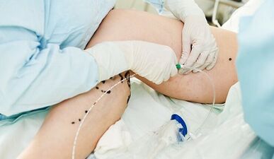 Μέθοδοι για τη θεραπεία των κιρσών των φλεβών στα πόδια στις γυναίκες