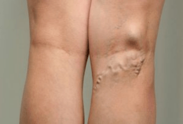 Διάγνωση κιρσών σε έγκυες γυναίκες