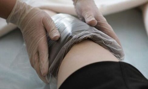 θεραπεία κιρσών με κομπρέσες